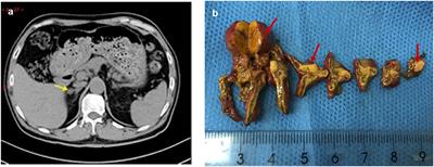 Abnormal Dexamethasone Suppression Tests in a Rifapentine-Treated Patient With Primary Aldosteronism